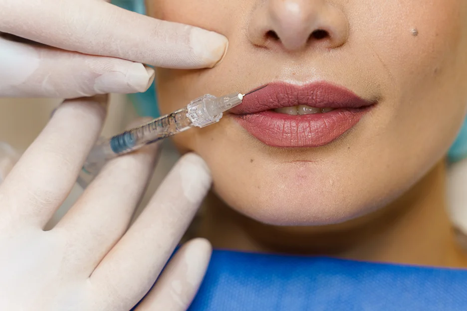 can you smoke after lip fillers