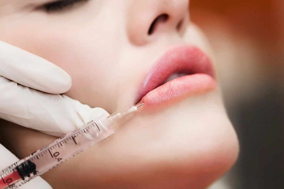Close-up of a medical professional injecting lip filler into a patient’s lips during treatment, illustrating the swelling stage of the procedure.