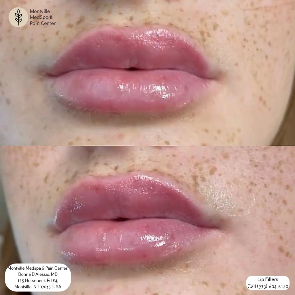 Before and after comparison of a patient’s lips showing fuller, plumper results following lip filler treatment at Montville MedSpa & Pain Center.