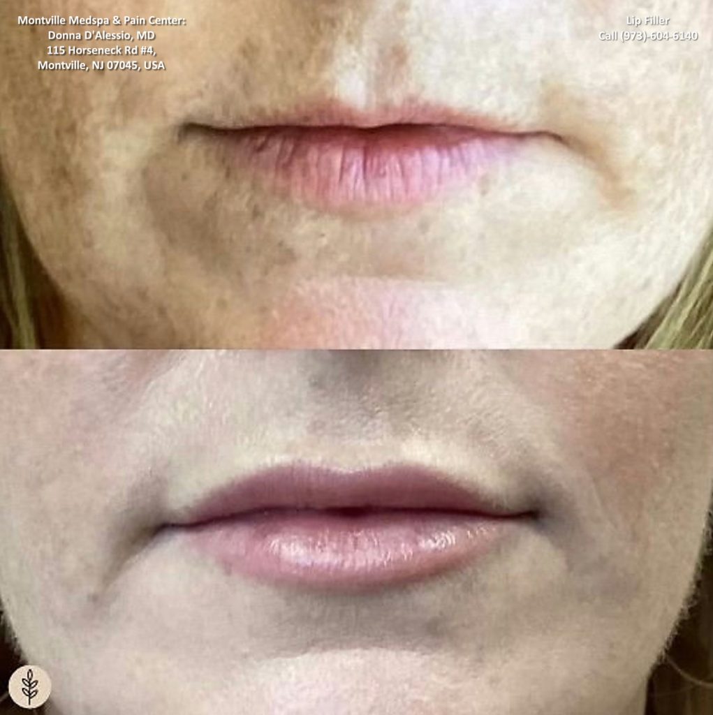 lip filler treatments at Montville Medspa