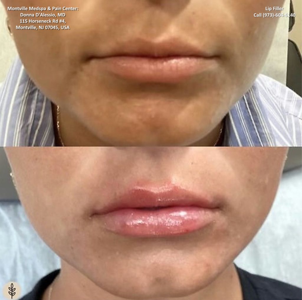 lip filler treatments at Montville Medspa