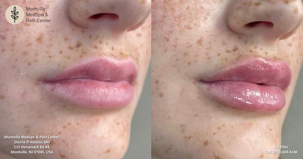 lip filler treatments at Montville Medspa