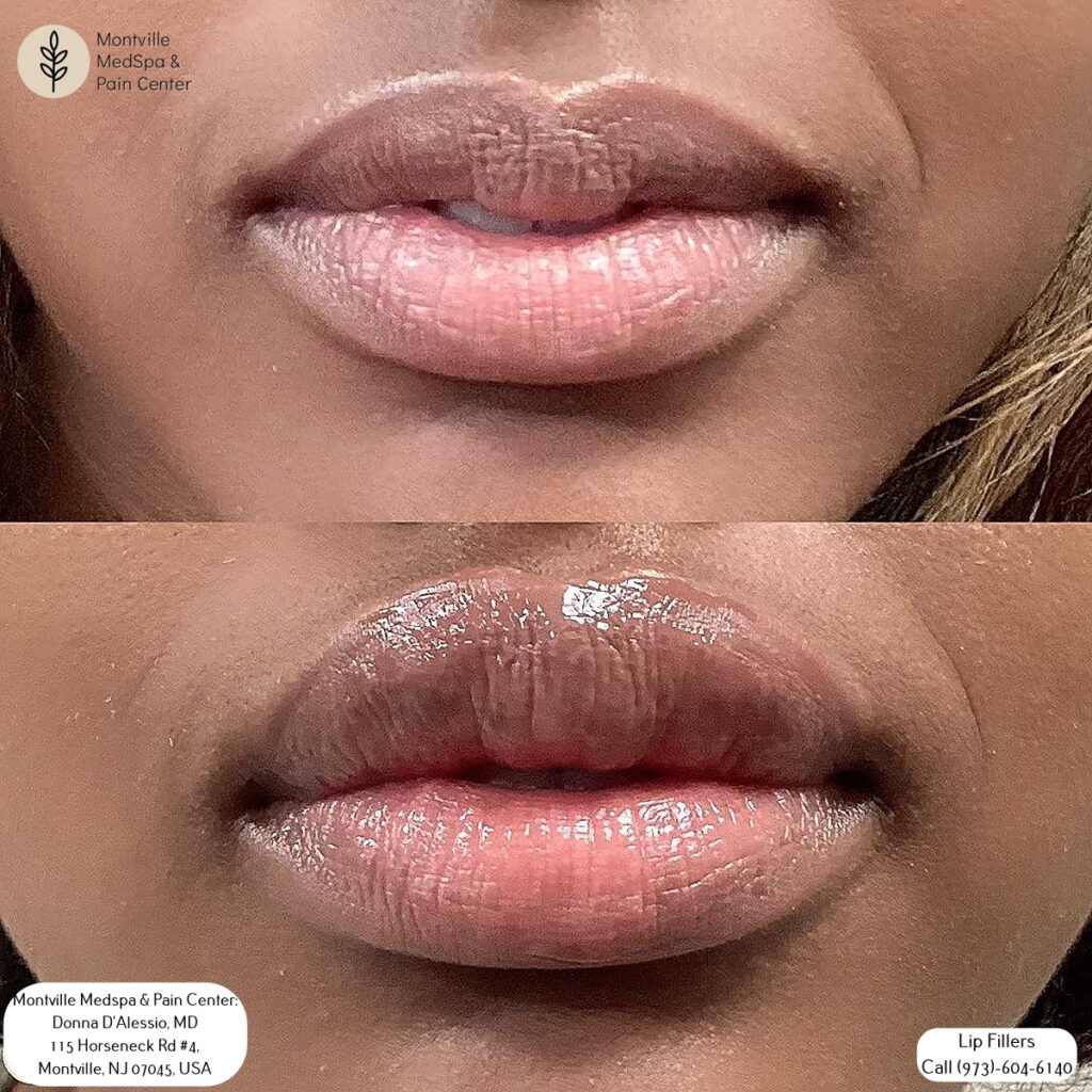 lip filler treatment at Montville Medspa & Pain Center
