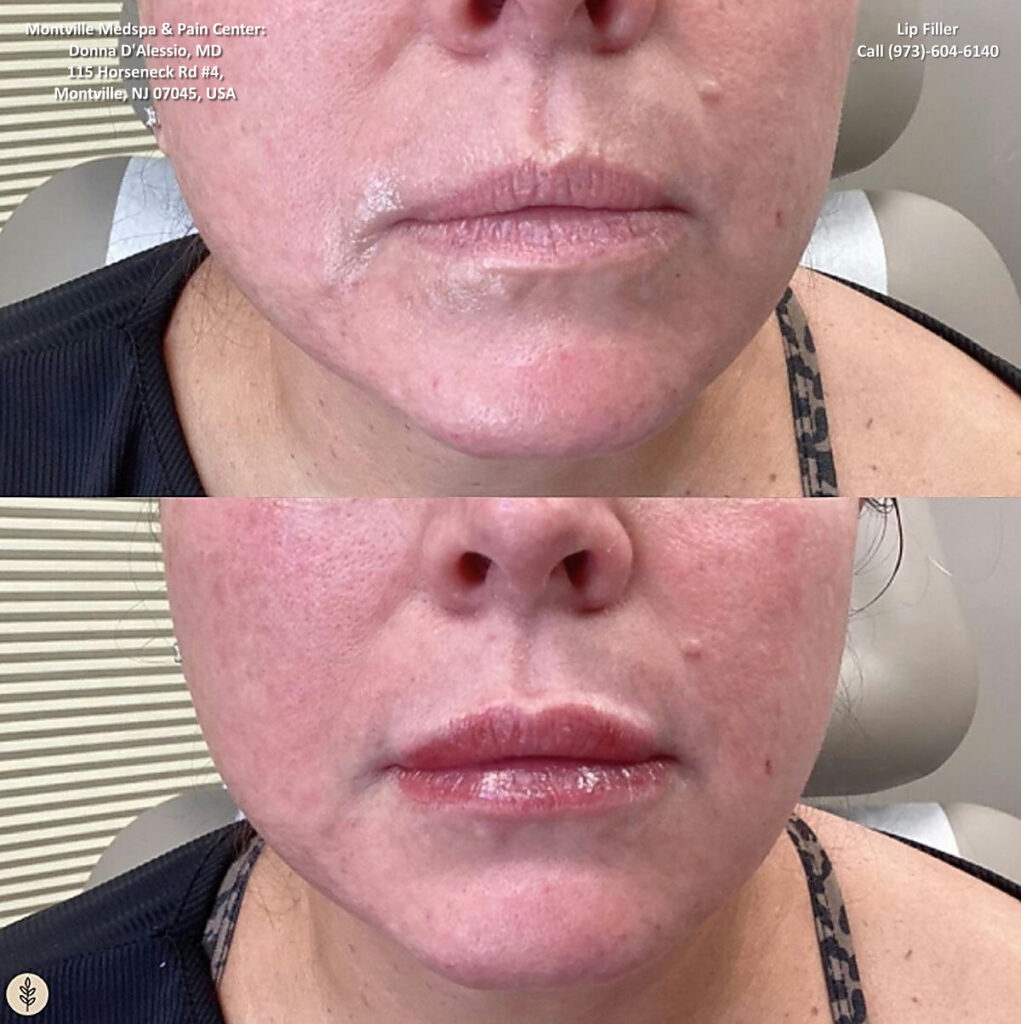 lip filler treatment at Montville Medspa & Pain Center